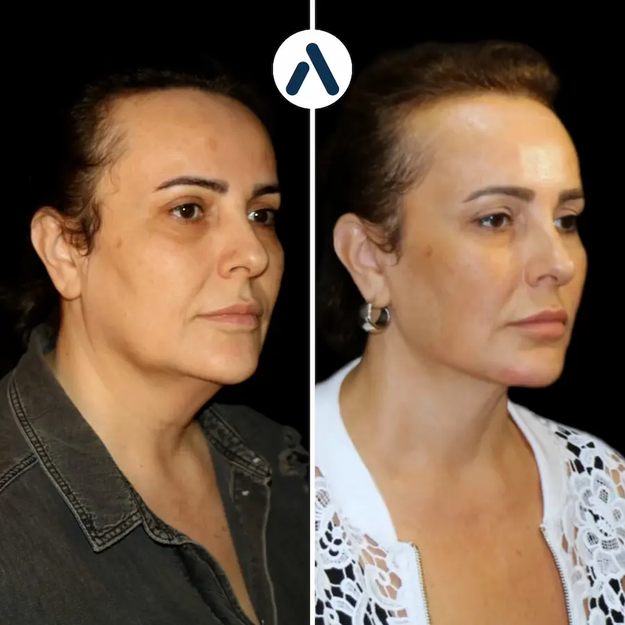 Deep Plane Facelift Before and After