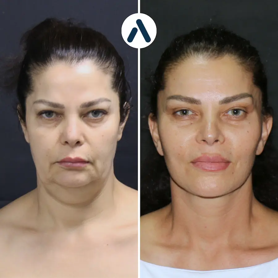 Deep Plane Face Lift Cost Turkey