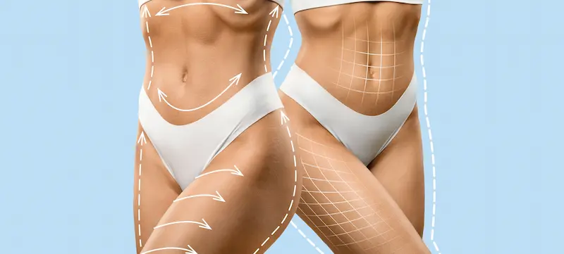 Liposuction in Turkey Cost