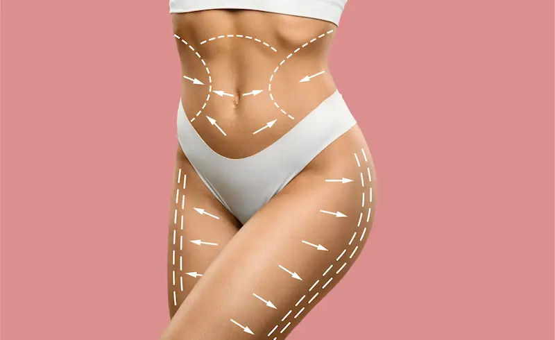 Liposuction in Turkey Before and After