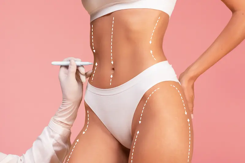 VASER Liposuction Before and After