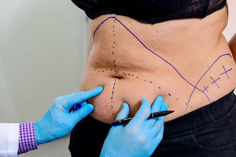 Abdominoplasty Cost Turkey