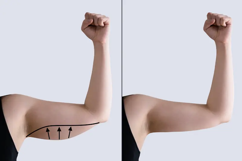 Arm Liposuction Before and After