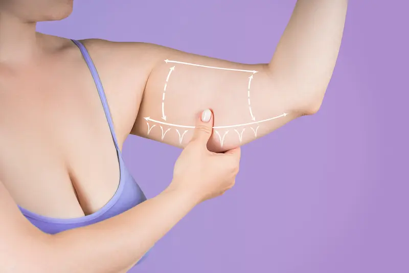 Arm Liposuction in Turkey