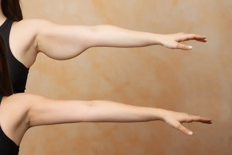 Arm Lift Before and After