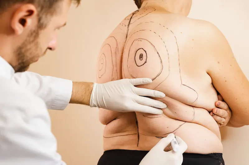 Back Liposuction in Turkey