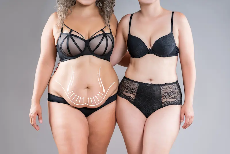 Extended Tummy Tuck Before and After
