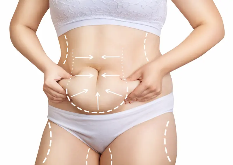Extended Tummy Tuck in Turkey