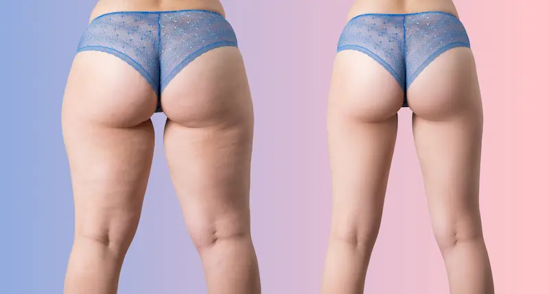 Leg Liposuction Before and After