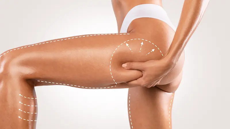Leg Liposuction Cost in Turkey