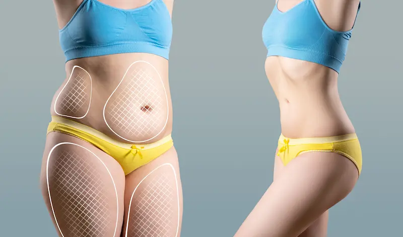 360 Lipo Before and After