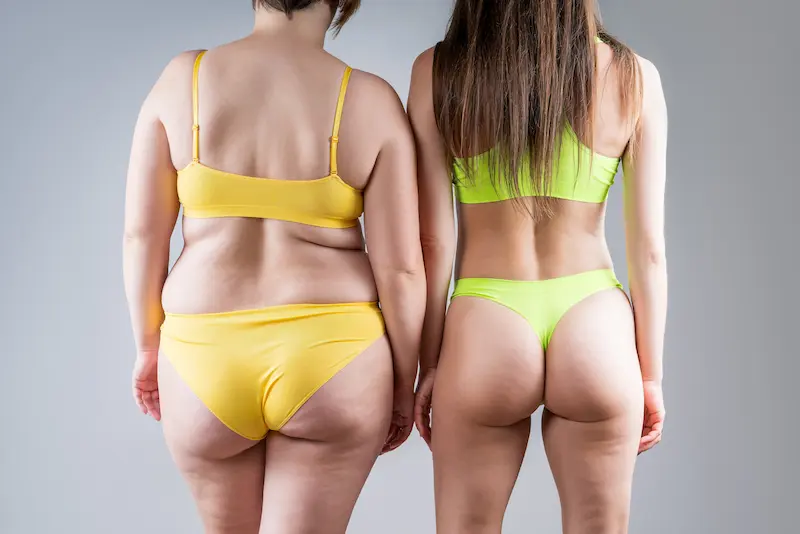 Liposuzione Prima e Dopo