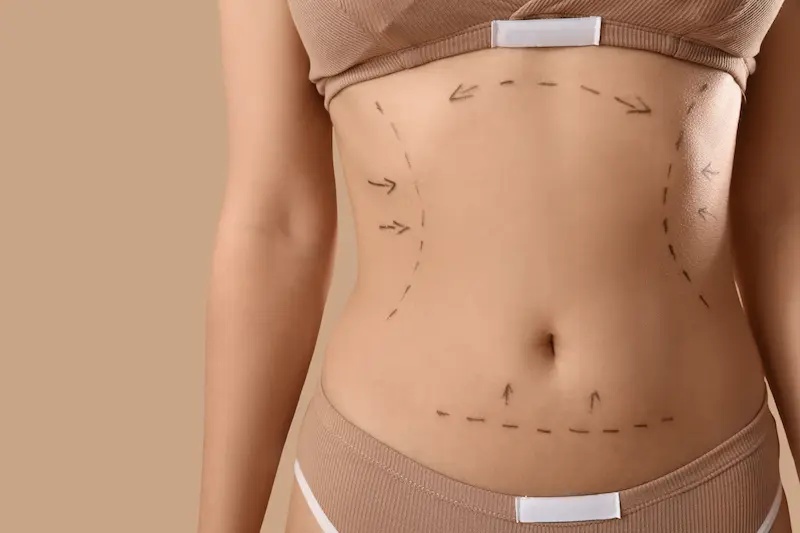 Mini Tummy Tuck in Turkey