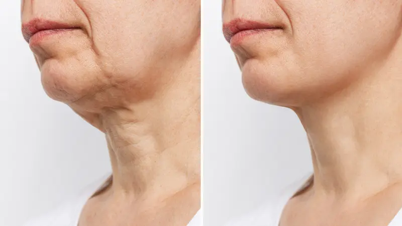 Neck Lift Before and After