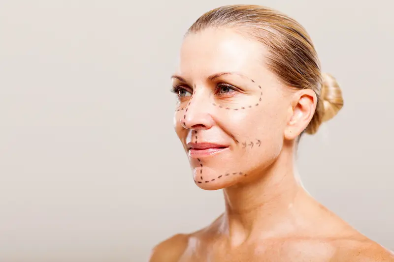 Revision Facelift Before and After