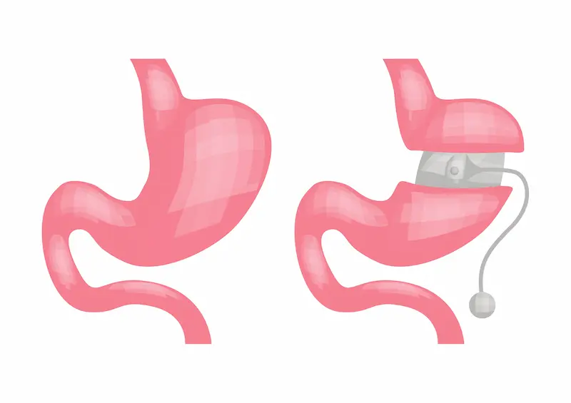 Rimozione del Bendaggio Gastrico