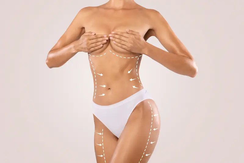 SmartLipo Before and After