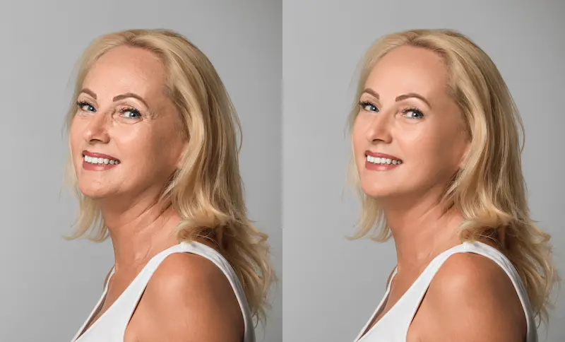SMAS Face Lift Before and After