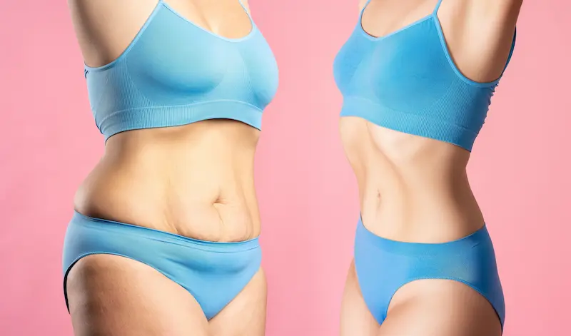 Stomach Liposuction Before and After
