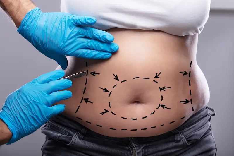 Tummy Tuck Cost Turkey